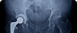 Total Hip Replacements