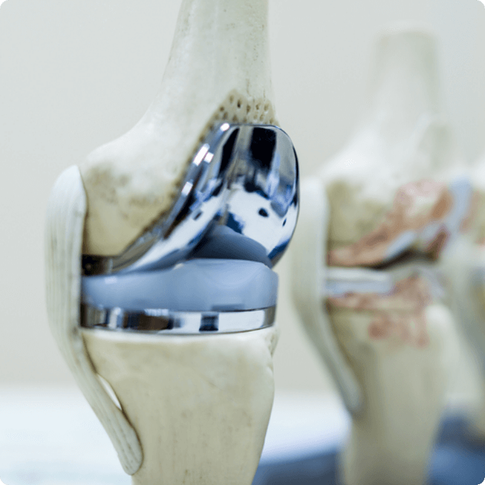 Full Knee replacement