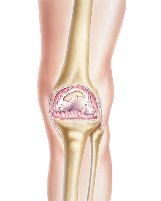 knee-osteoarthritis-joint-noninflammatory-degenerative-disease-characterized-breakdown-s-cartilage-cartilage-82156066